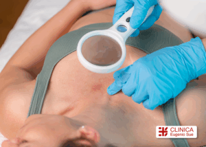 dermatitis por estres